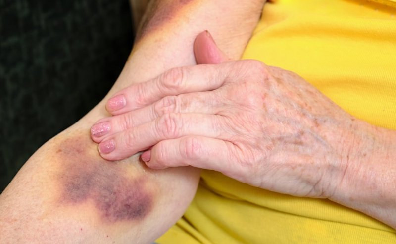 old-woman-with-hematoma
